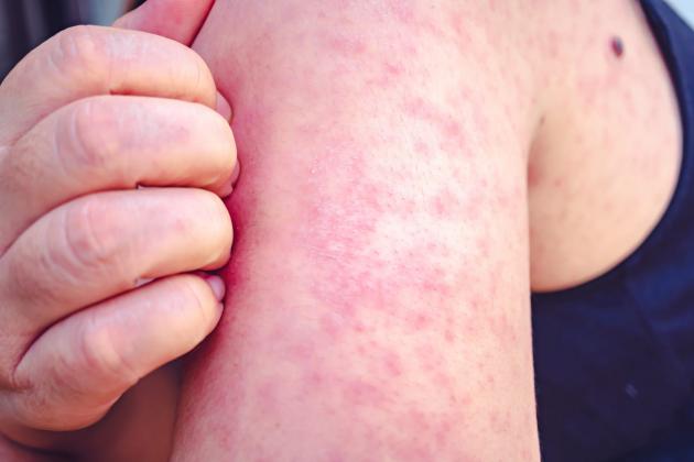 Person with measles visited several spots in Ocean City, cuing warning